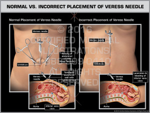 Exhibit of Normal vs. Incorrect Placement of Veress Needle