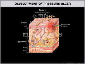 Development of Pressure Ulcer - Stage 1 Development of Pressure Ulcer - Stage 1