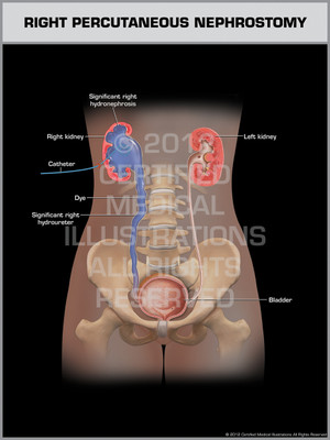 Right Percutaneous Nephrostomy Right Percutaneous Nephrostomy