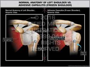 Exhibit of Normal Anatomy of Left Shoulder vs. Adhesive Capsulitis (Frozen Shoulder) Exhibit of Normal Anatomy of Left Shoulder vs. Adhesive Capsulitis (Frozen Shoulder)