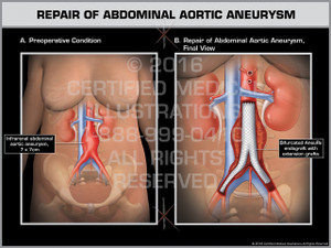 Exhibit of Repair of Abdominal Aortic Aneurysm