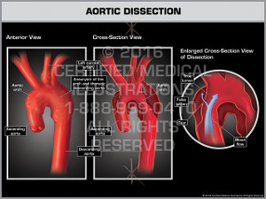 Aortic Dissection