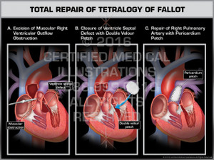 Exhibit of Total Repair of Tetralogy of Fallot- Print Quality Instant Download Exhibit of Total Repair of Tetralogy of Fallot- Print Quality Instant Download