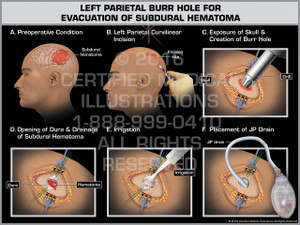 Exhibit of Left Parietal Burr Hole for Evacuation of Subdural Hematoma Exhibit of Left Parietal Burr Hole for Evacuation of Subdural Hematoma