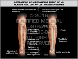Exhibit of Comparison of Maisonneuve Fracture vs. Normal Anatomy of Left Lower Extremity