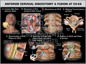 Exhibit of Anterior Cervical Discectomy & Fusion at C5-C6 Exhibit of Anterior Cervical Discectomy & Fusion at C5-C6