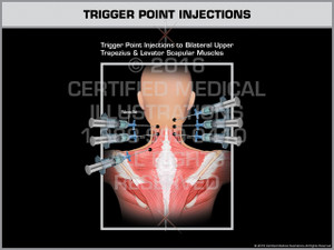 Exhibit of Trigger Point Injections - Print Quality Instant Download Exhibit of Trigger Point Injections - Print Quality Instant Download
