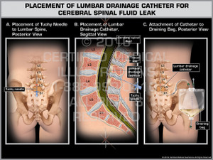 Exhibit of Placement of Lumbar Drainage Catheter for Cerebral Spinal Fluid Leak Exhibit of Placement of Lumbar Drainage Catheter for Cerebral Spinal Fluid Leak