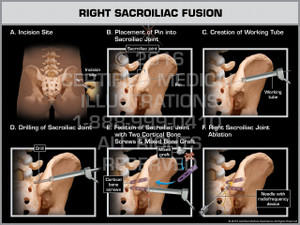 Exhibit of Right Sacroiliac Fusion - Print Quality Instant Download Exhibit of Right Sacroiliac Fusion - Print Quality Instant Download