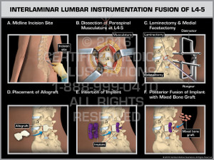 Exhibit of Interlaminar Lumbar Instrumentation Fusion of L4-5 Exhibit of Interlaminar Lumbar Instrumentation Fusion of L4-5