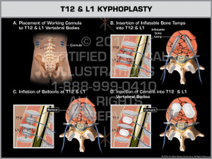 Exhibit of T12 & L1 Kyphoplasty