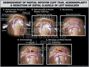Exhibit of Debridement of Partial Rotator Cuff Tear, Acromioplasty & Resection of Distal Clavicle of Left Shoulder Exhibit of Debridement of Partial Rotator Cuff Tear, Acromioplasty & Resection of Distal Clavicle of Left Shoulder
