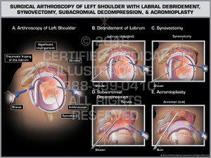 Exhibit of Surgical Arthroscopy of Left Shoulder with Labral Debridement, Synovectomy, Subacromial Decompression & Acromioplasty