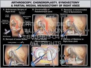 Exhibit of Arthroscopy, Chondroplasty, Synovectomy, & Partial Medial Meniscectomy of Right Knee Exhibit of Arthroscopy, Chondroplasty, Synovectomy, & Partial Medial Meniscectomy of Right Knee