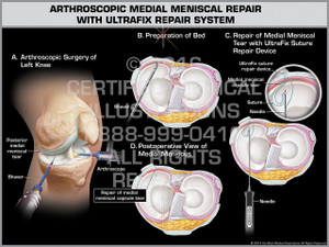 Exhibit of Arthroscopic Medial Meniscal Repair with UltraFix Repair System
