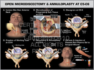 Exhibit of Open Microdiscectomy & Annuloplasty at C5-C6