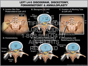 Exhibit of Left L4-5 Discogram, Discectomy, Foraminotomy & Annuloplasty - Print Quality Instant Download Exhibit of Left L4-5 Discogram, Discectomy, Foraminotomy & Annuloplasty - Print Quality Instant Download