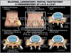 Exhibit of Bilateral Laminotomy, Partial Facetectomy & Foraminotomy at L4-5 & L5-S1 Exhibit of Bilateral Laminotomy, Partial Facetectomy & Foraminotomy at L4-5 & L5-S1