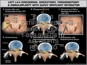 Exhibit of Left L4-5 Discogram, Discectomy, Foraminotomy & Annuloplasty with DePuy Spotlight Retractor