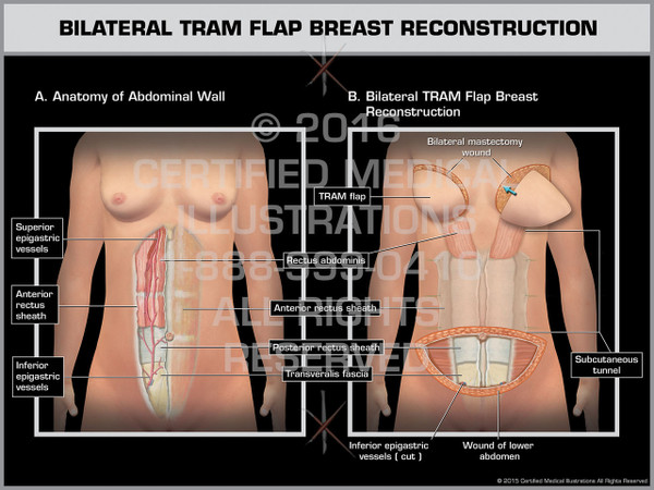 Exhibit of Bilateral TRAM Flap Breast Reconstruction 1