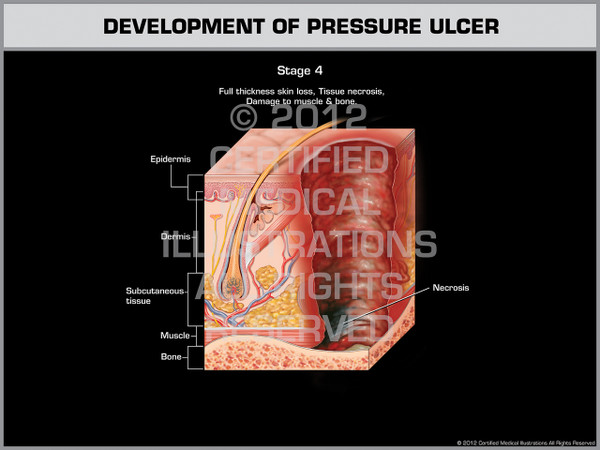 Exhibit of Development of Pressure Ulcer - Stage 4