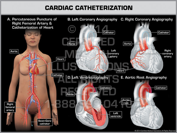 Exhibit of Cardiac Catheterization Female