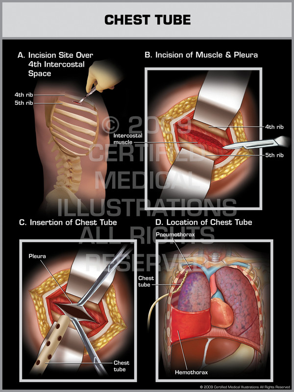 Exhibit of Chest Tube Mal