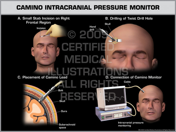 Exhibit of Camino Intracranial Pressure Monitor Male