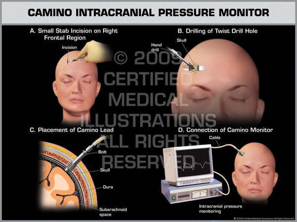 Exhibit of Camino Intracranial Pressure Monitor Female