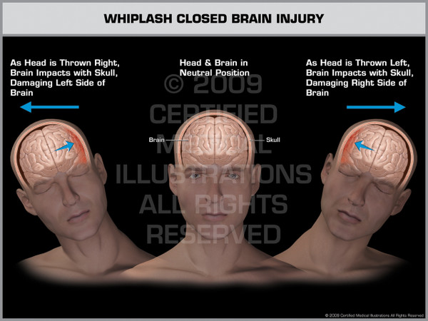 Exhibit of Whiplash Closed Brain Injury Male
