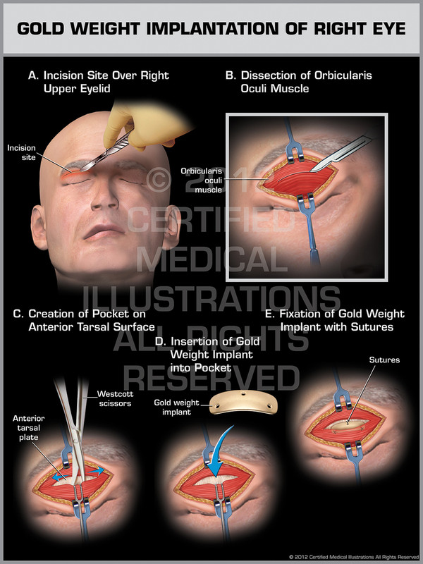 Exhibit of Gold Weight Implantation of Right Eye