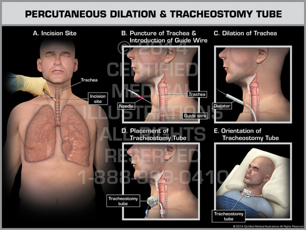 Exhibit of Percutaneous Dilation & Tracheostomy Tube Male