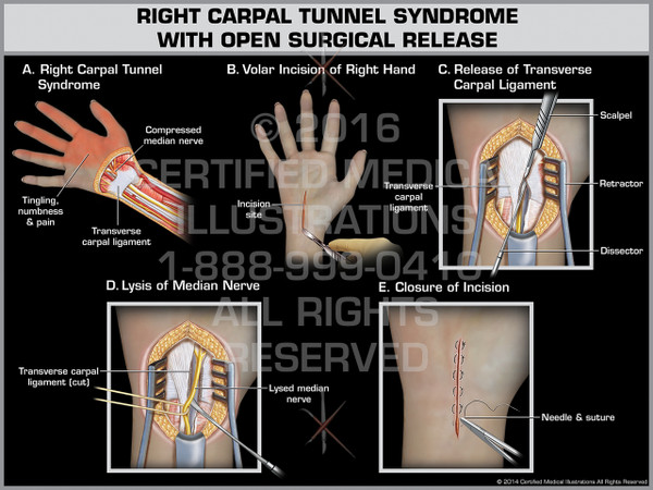 Exhibit of Right Carpal Tunnel Syndrome with Open Surgical Release