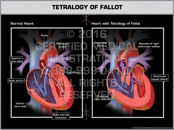Exhibit of Tetralogy of Fallot - Print Quality Instant Download