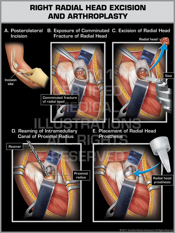 Right Radial Head Excision and Athroplasty