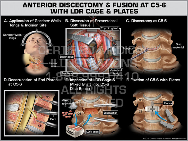Exhibit of Anterior Discectomy & Fusion at C5-6 with LDR Cage & Plates - Print Quality Instant Download 