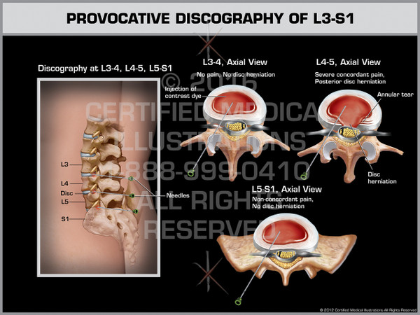 Exhibit of Provocative Discography of L3-S1