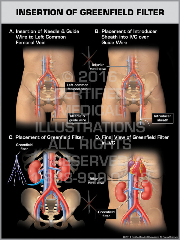 Exhibit of Insertion of Greenfield Filter Exhibit of Insertion of Greenfield Filter