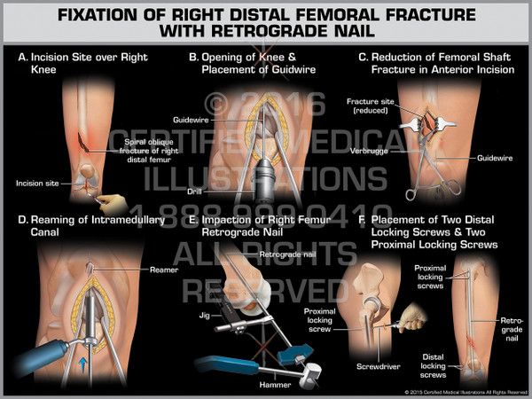 Exhibit of Fixation of Right Distal Femoral Fracture with Retrograde Nail - Print Quality Instant Download