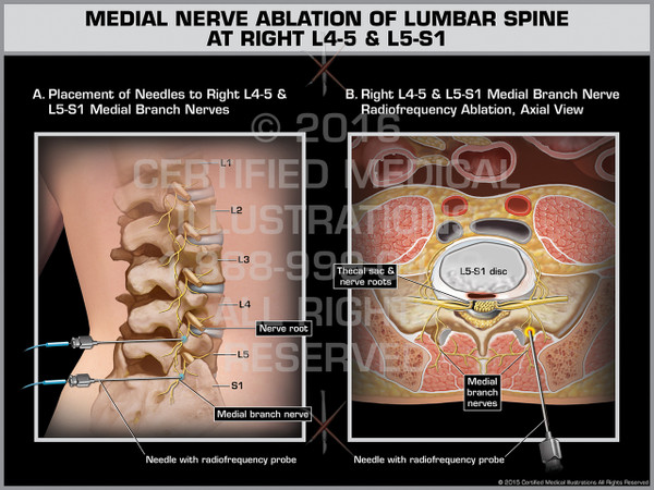 Exhibit of Medial Nerve Ablation of Lumbar Spine at Right L4-5 & L5-S1 - Print Quality Instant Download