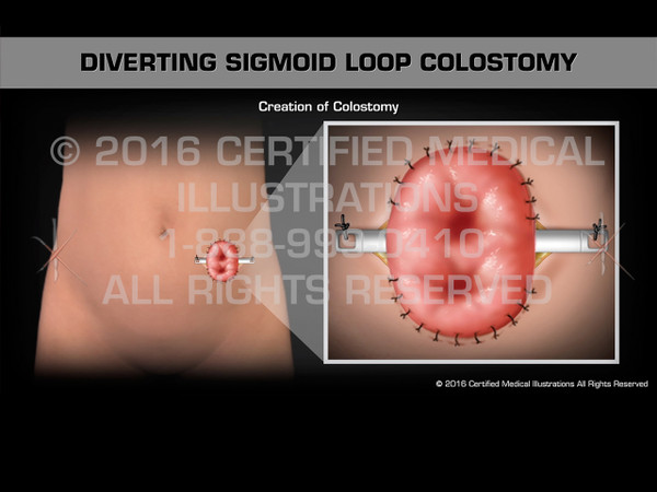 Animation of Diverting Sigmoid Loop Colostomy - Medical Animation