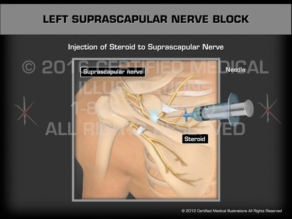 Animation of Left Suprascapular Nerve Block - Medical Animation