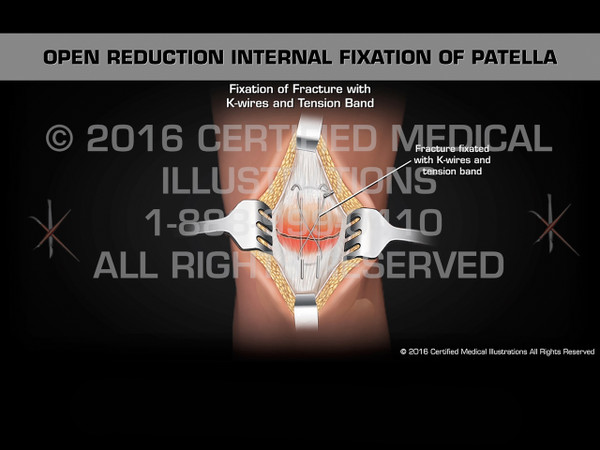 Animation of Open Reduction Internal Fixation of Patella - Medical Animation