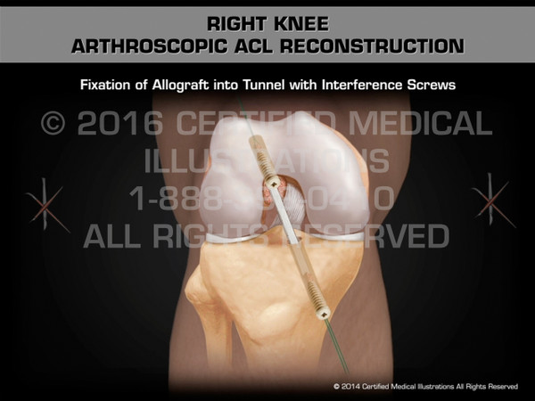 Animation of Right Knee Arthroscopic ACL Reconstruction - Medical Animation