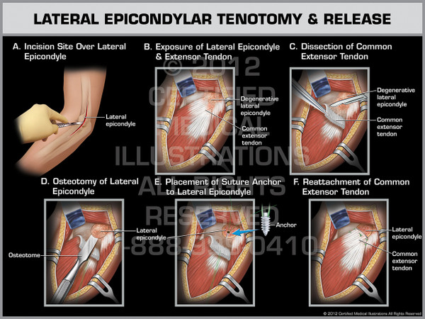 Lateral Epicondylar Tenotomy & Release