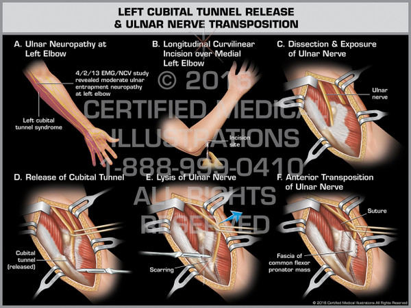 Exhibit of Left Cubital Tunnel Release & Ulnar Nerve Transposition