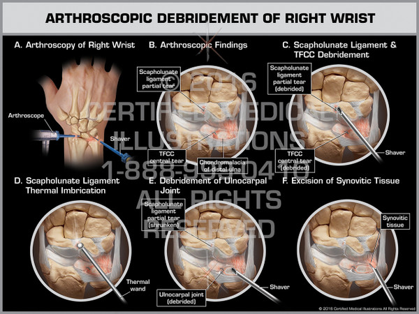Exhibit of Arthroscopic Debridement of Right Wrist