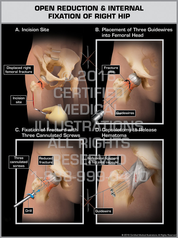 Exhibit of Open Reduction & Internal Fixation of Right Hip