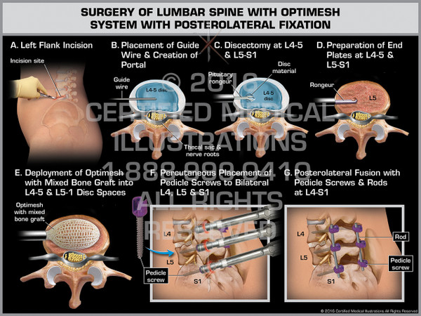 Exhibit of Surgery of Lumbar Spine with Optimesh System with Posterolateral Fixation - Print Quality Instant Download