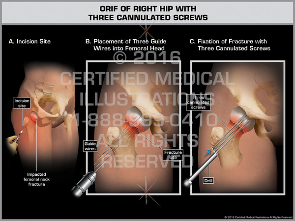 Exhibit of ORIF of Right Hip with Three Cannulated Screws